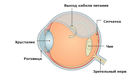Retina Implant, Чип, Имплантант