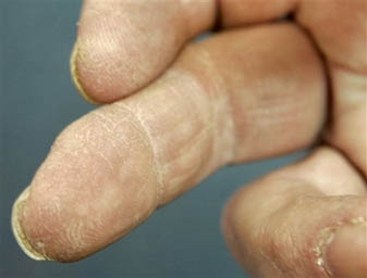 Порошок из свиного пузыря регенерирует пальцы