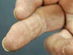 Порошок из свиного пузыря регенерирует пальцы