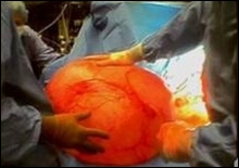 Американские хирурги удалили 40-кг. опухоль