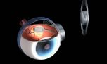 Британские хирурги "ставят" электронные глаза пациентам