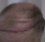 В США пациенту пересадили пол головы